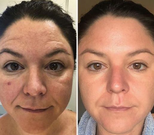 Before & After